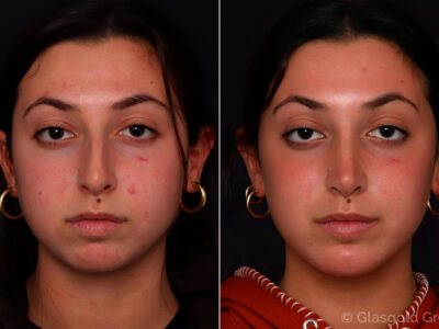 septoplasty in New Jersey